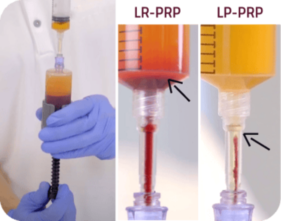 Decantazione del plasma
